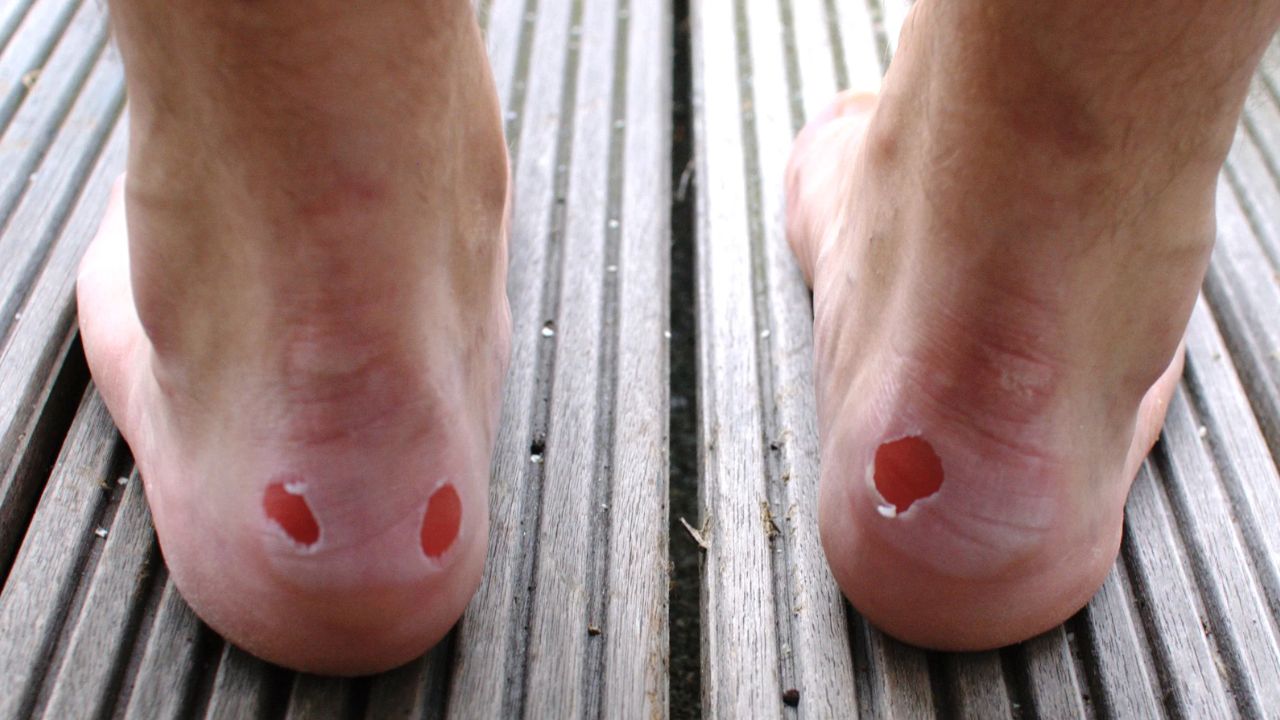 shoe blister