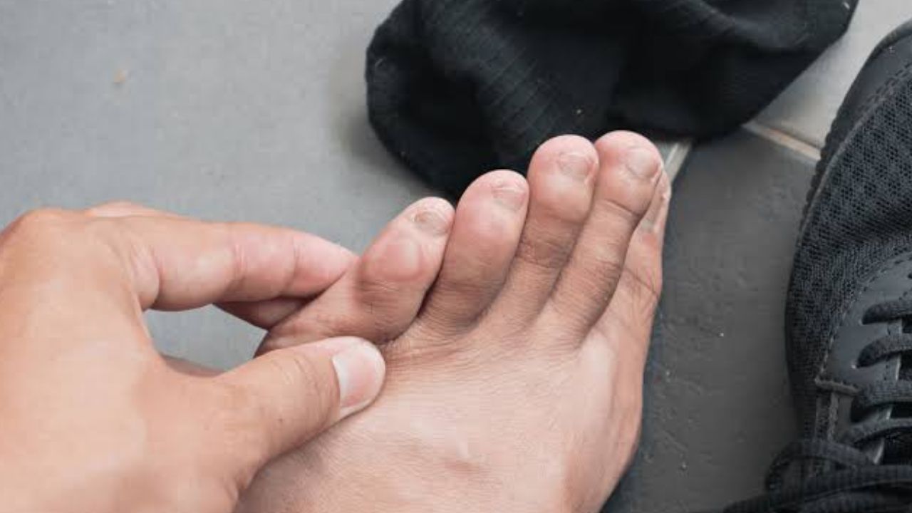 shoe blister